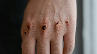 Deutschland erkennt Sepsis